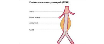 Carotid Stenting